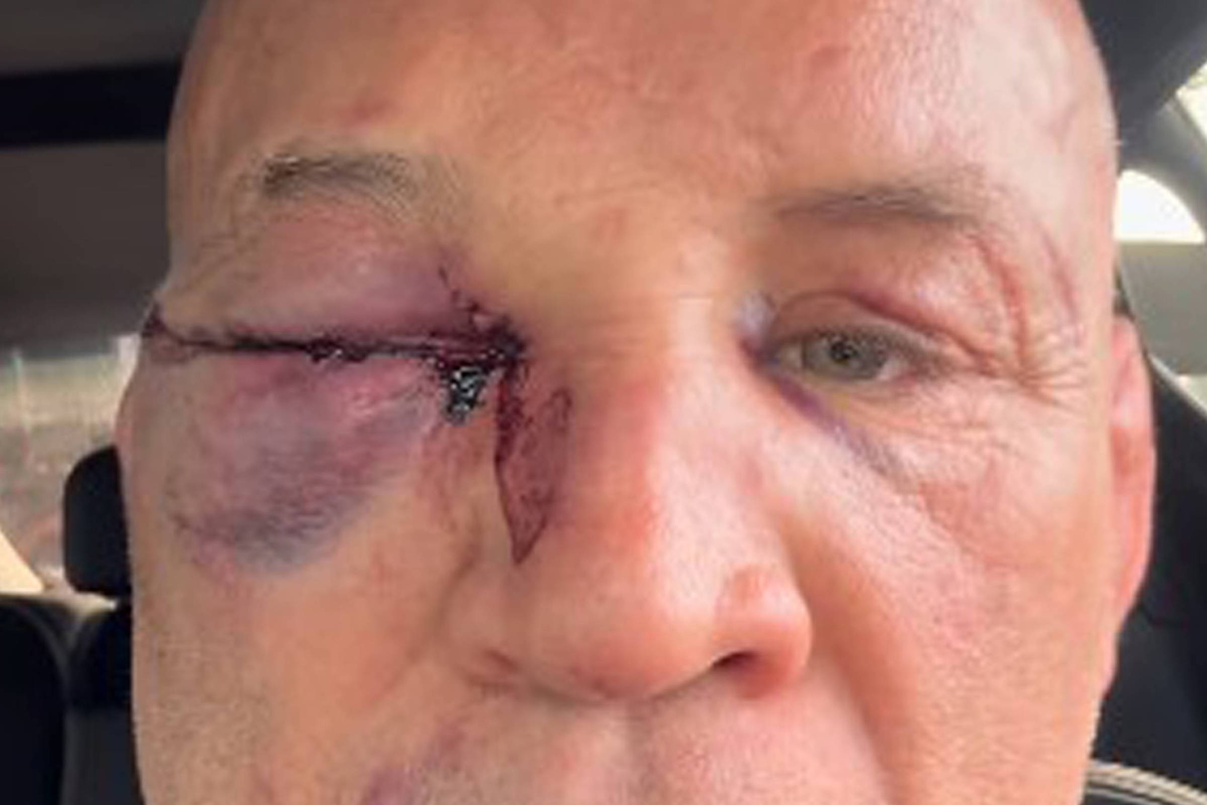 “Wanderlei Silva fala sobre persistente dor de cabeça” – 28/09/2025 – Esporte